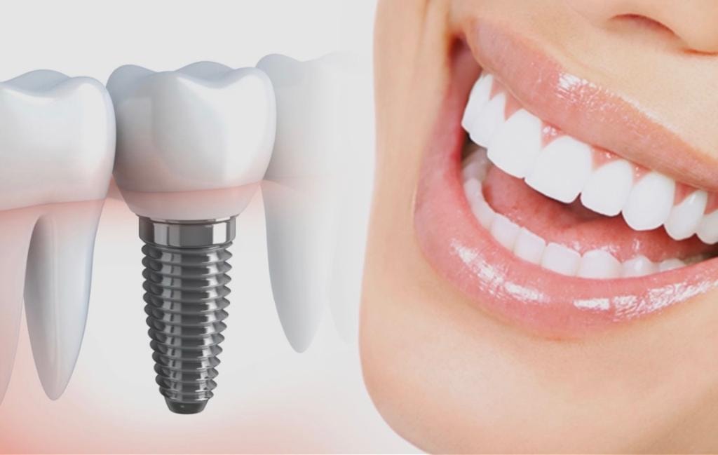 Dental implants